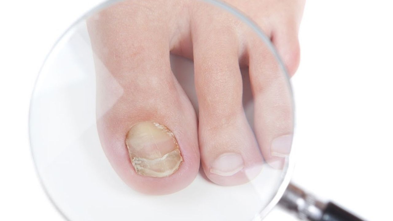 Fungal Infection of nail 