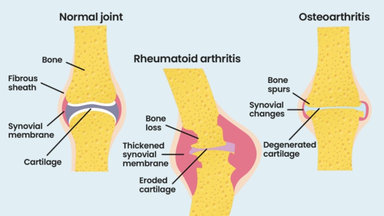 CHANGES IN THE JOINTS  in rheumatoid