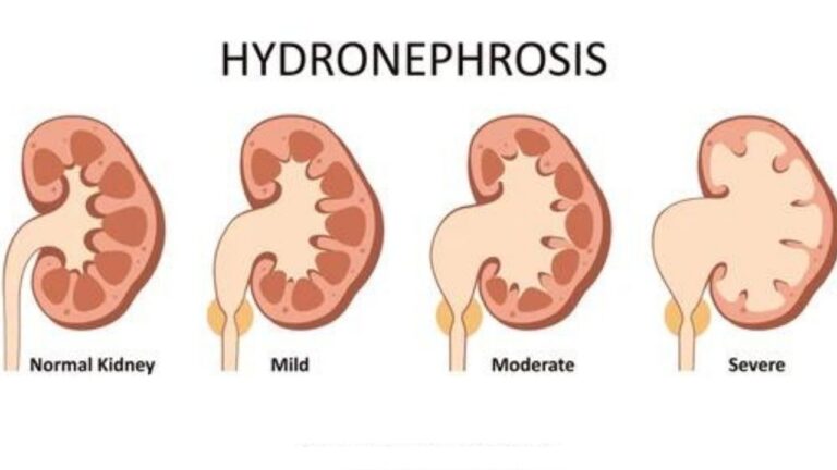 hydronephrosis