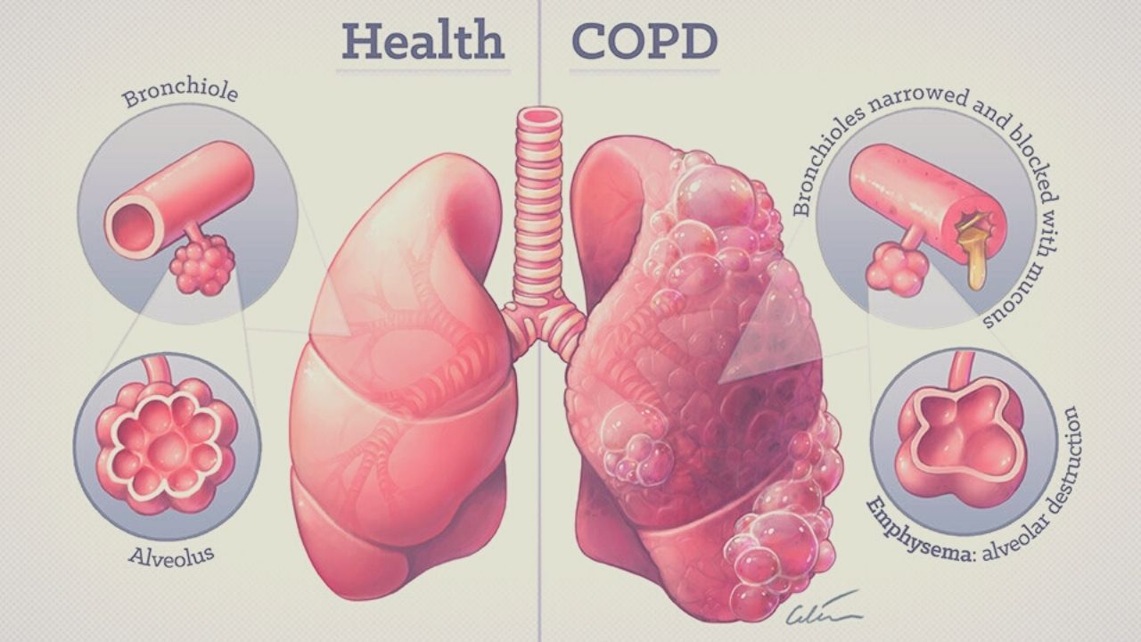COPD ICD 10