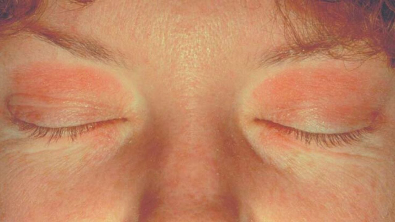 contact dermatitis eyelid