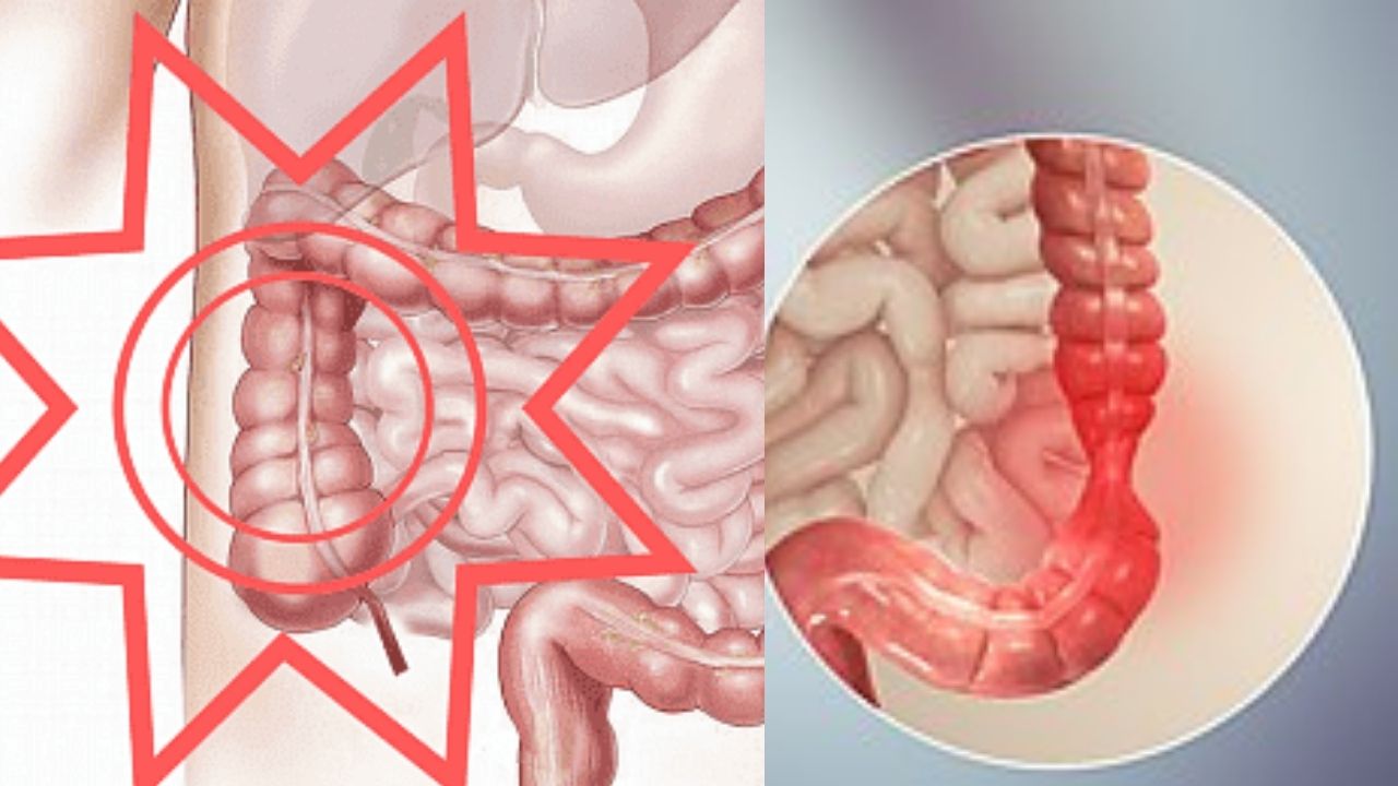 Irritable bowel syndrome (IBS) 