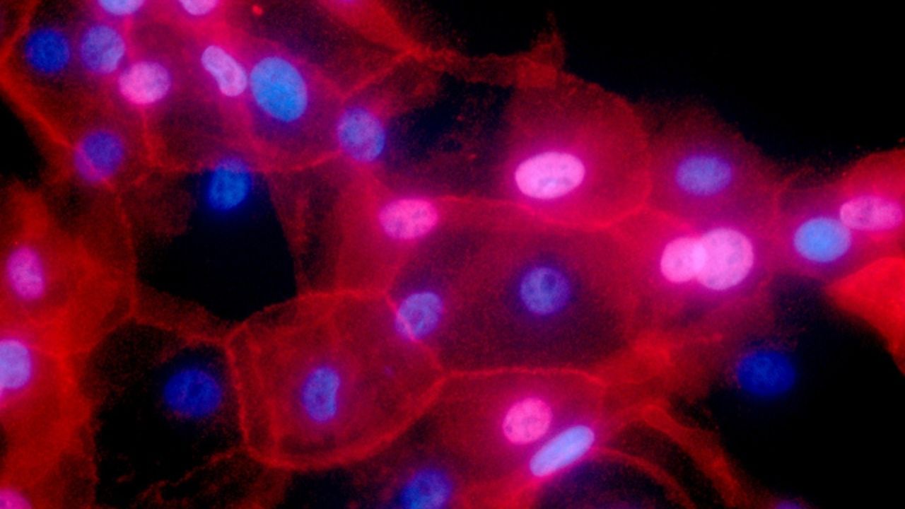 Tumor cells in the mammary gland