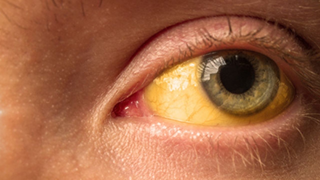 Yellow pigmentation of the eyes is characteristic of this infection.