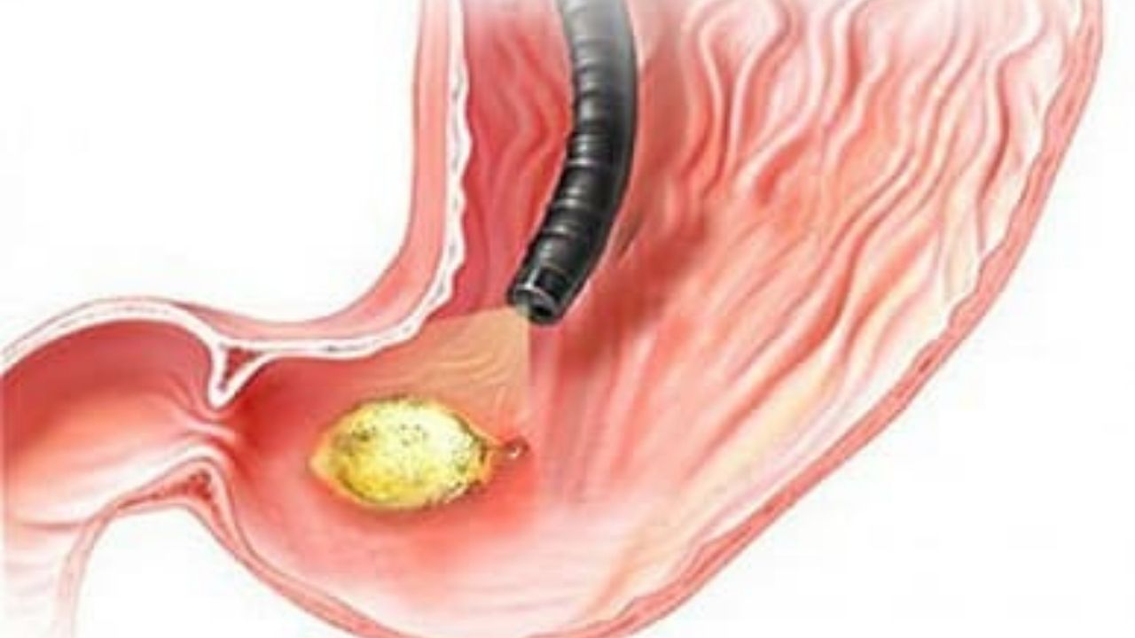 Peptic ulcer of the stomach