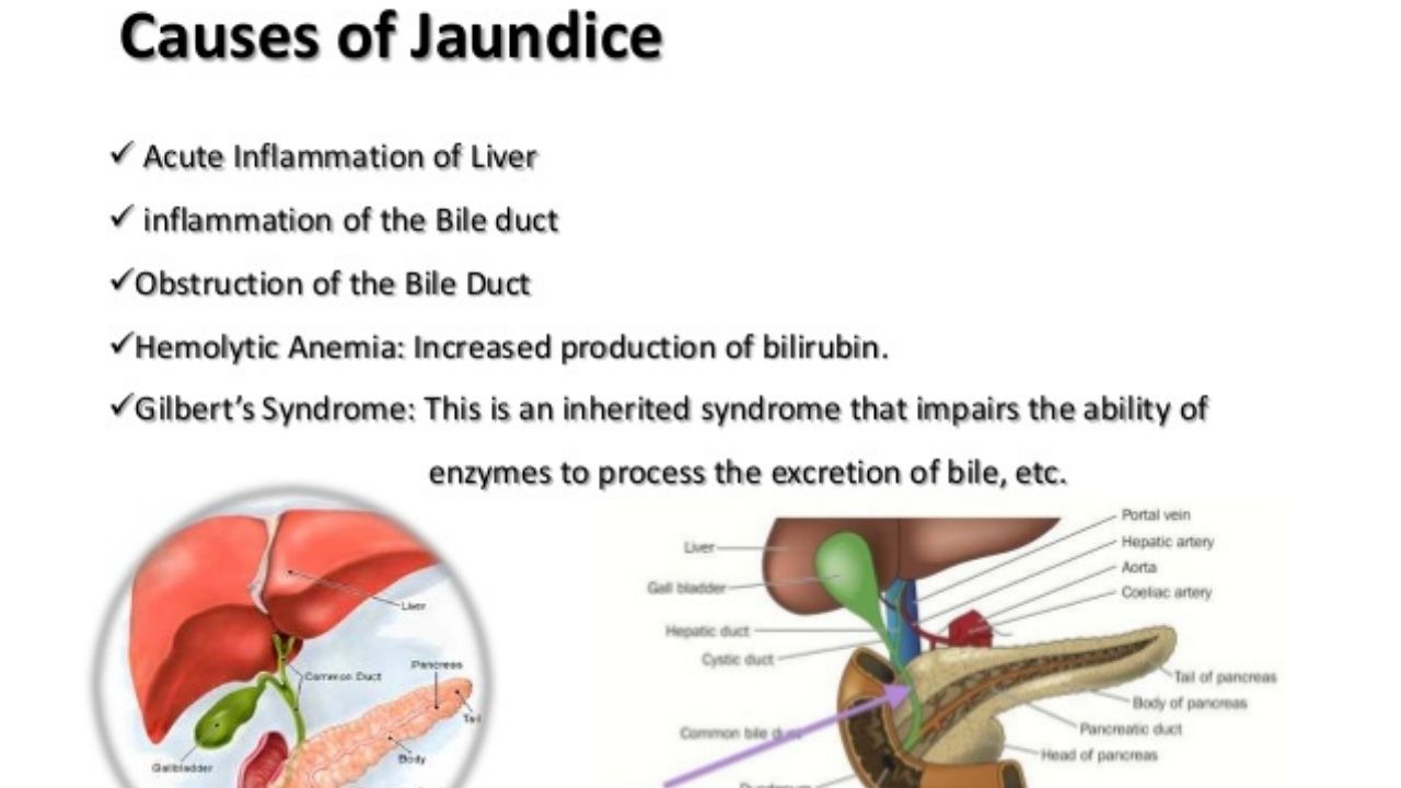 Causes of jaundice