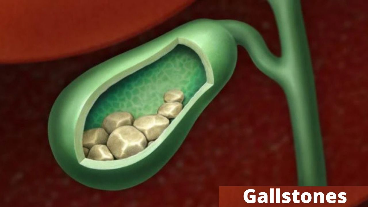 gallstones-treatment