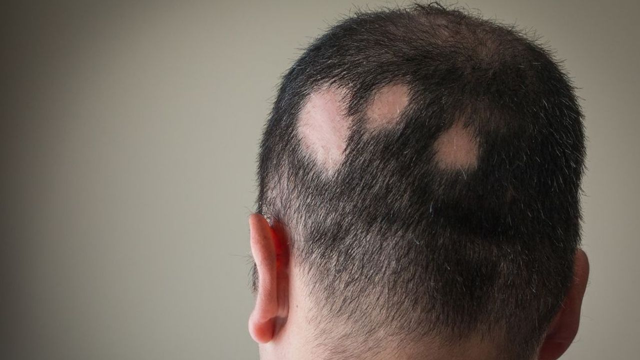 hair loss patches