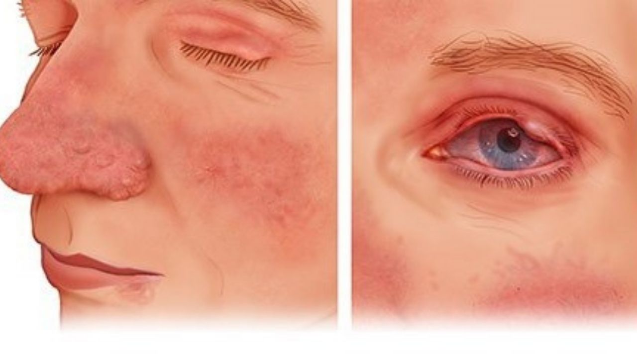 Picture of Rosacea type 3 and type 4