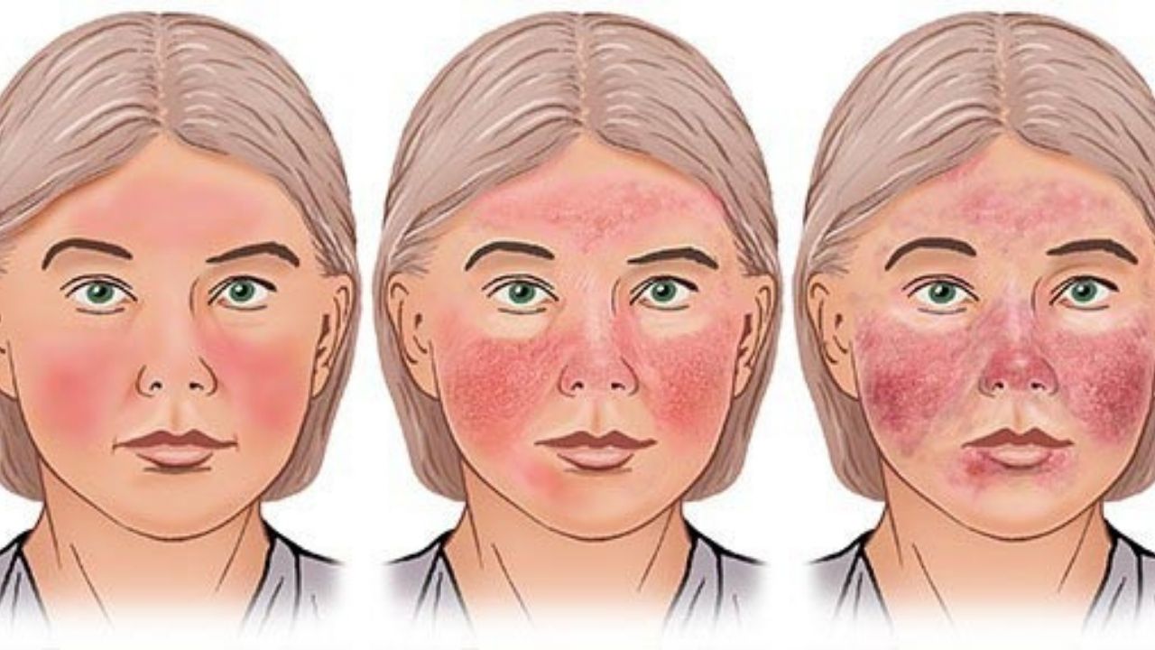 Picture of Rosacea type 1 and type 2