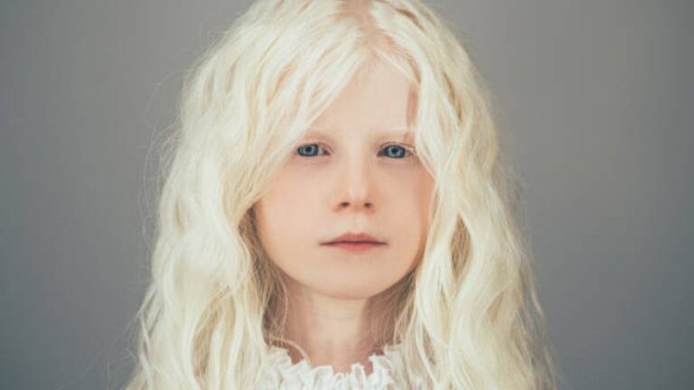 Albinism in human