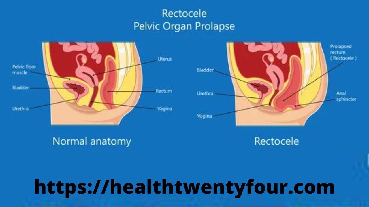 Posterior vaginal prolapse (rectocele)