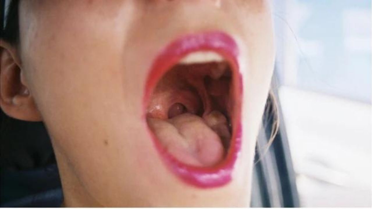 Oral Gonorrhea Symptoms