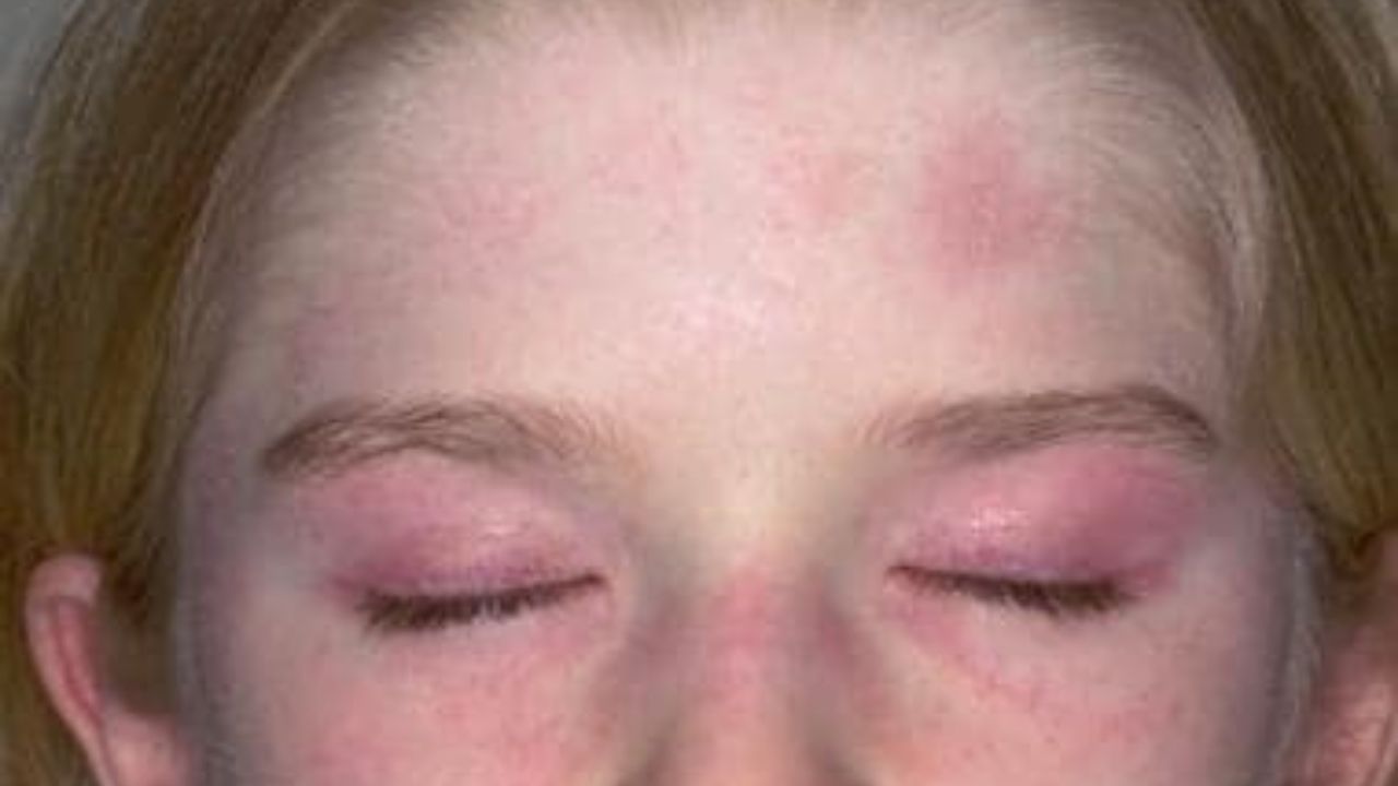 Juvenile Dermatomyositis Skin rashes