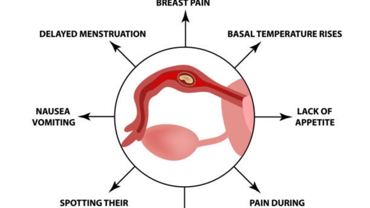 Ectopic pregnancy symptoms