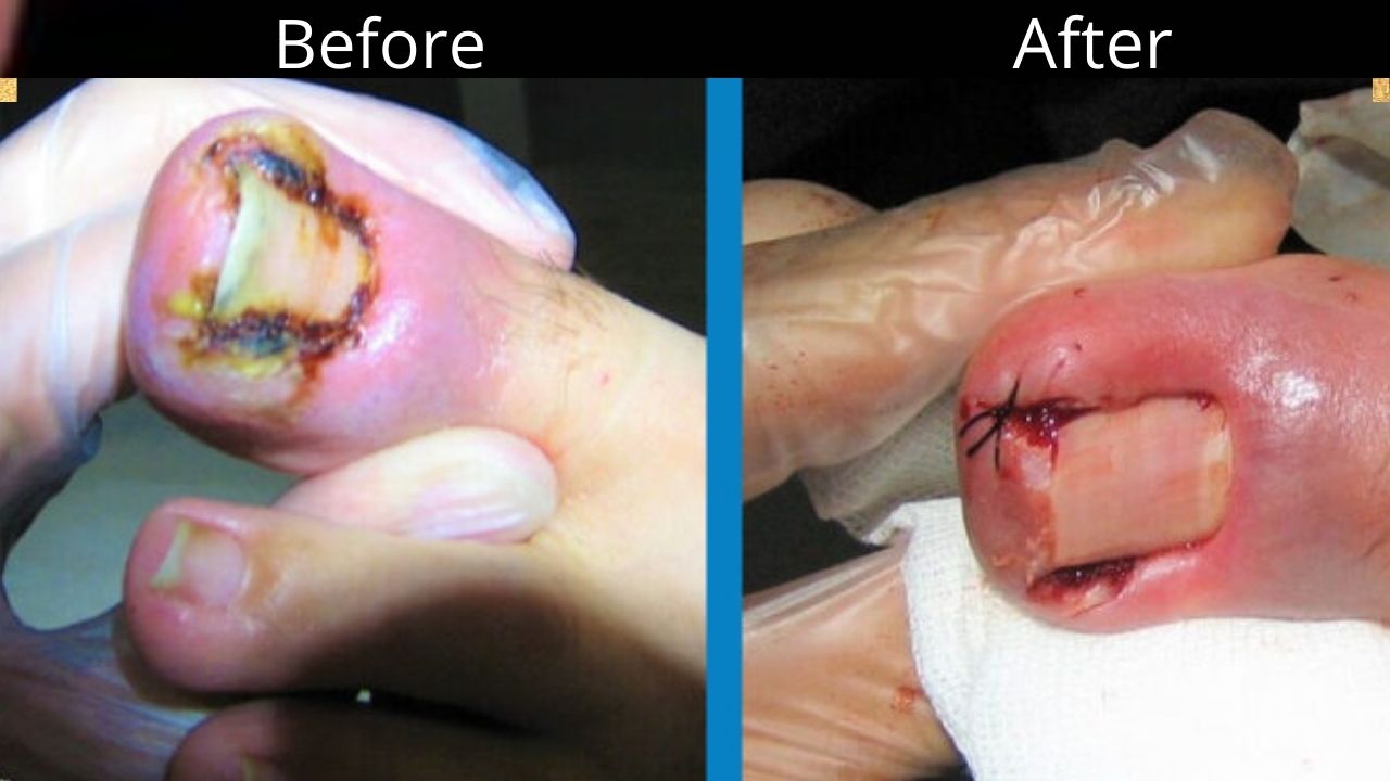 Ingrown toenail or onychocryptosis surgery before and after, photos.