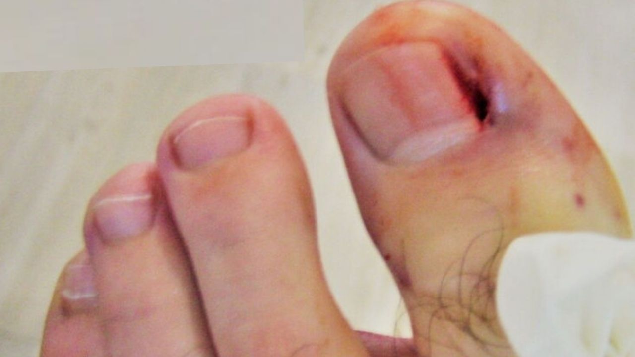 Moderate ingrown toenail after operation