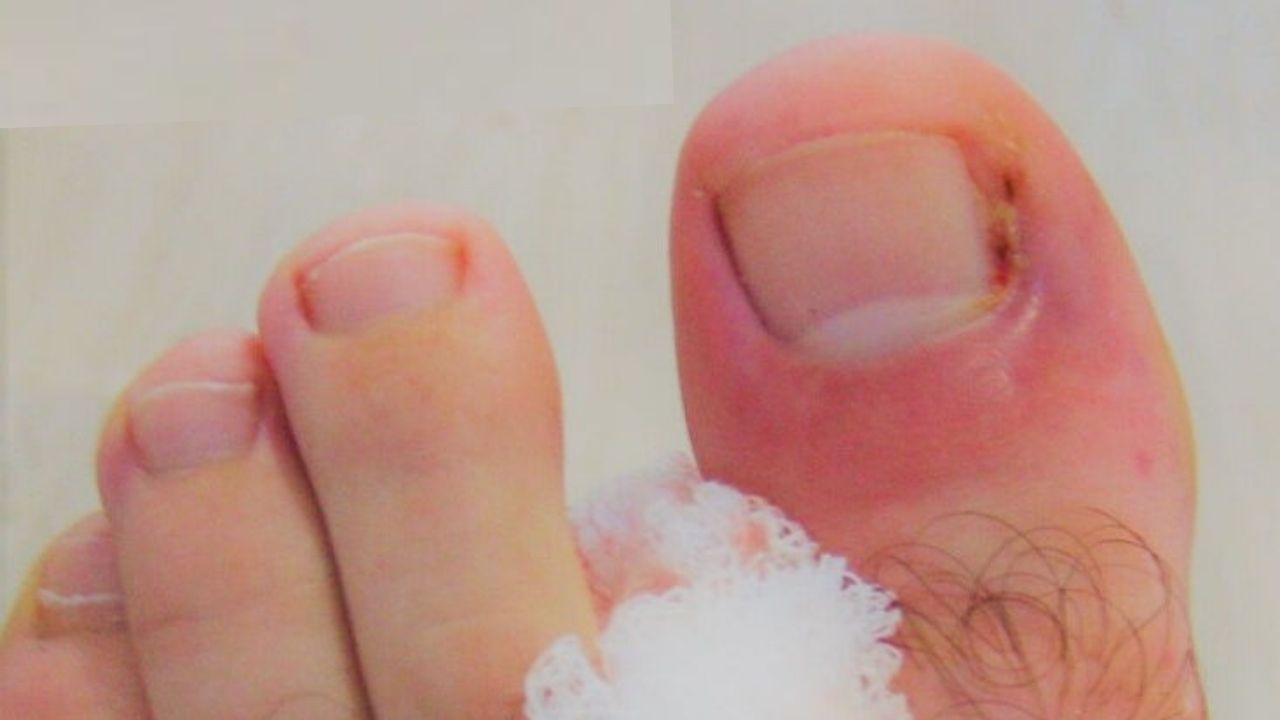 Mild ingrown toenail before surgery