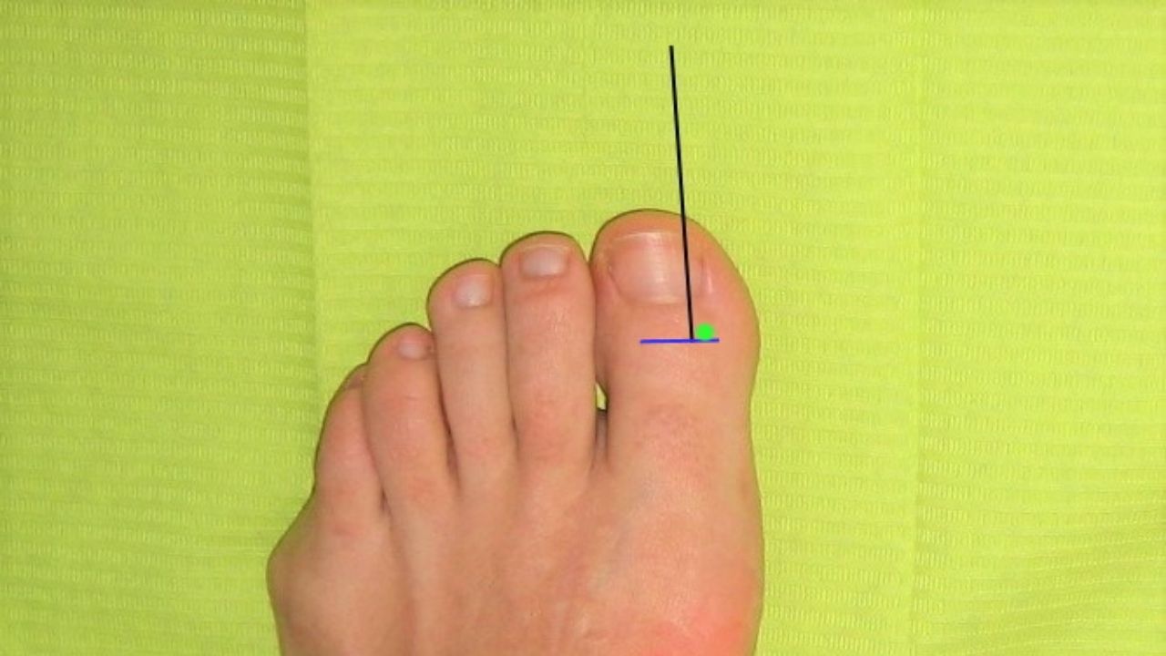 Photo to explain the ingrown or nailed toenail operation, in this foot there is no ingrown toenail pathology.