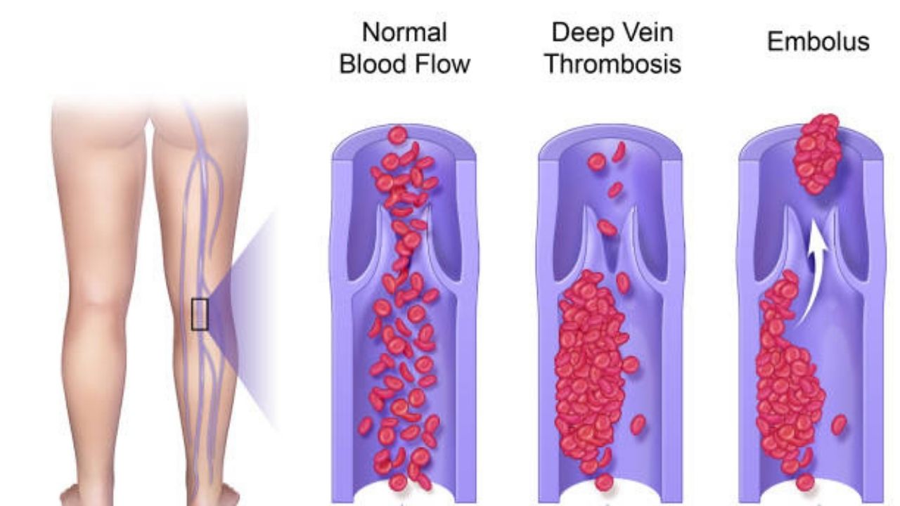 Embolism in legs or arms