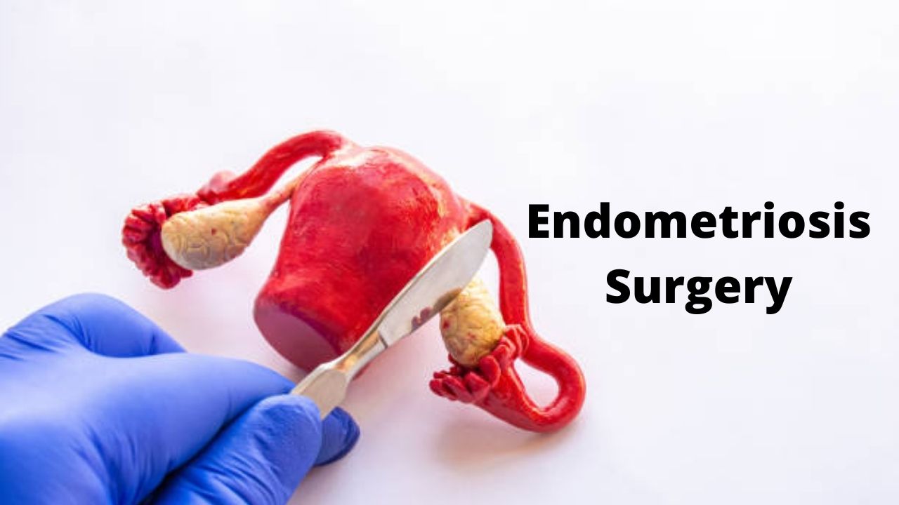 Endometriosis Surgery
