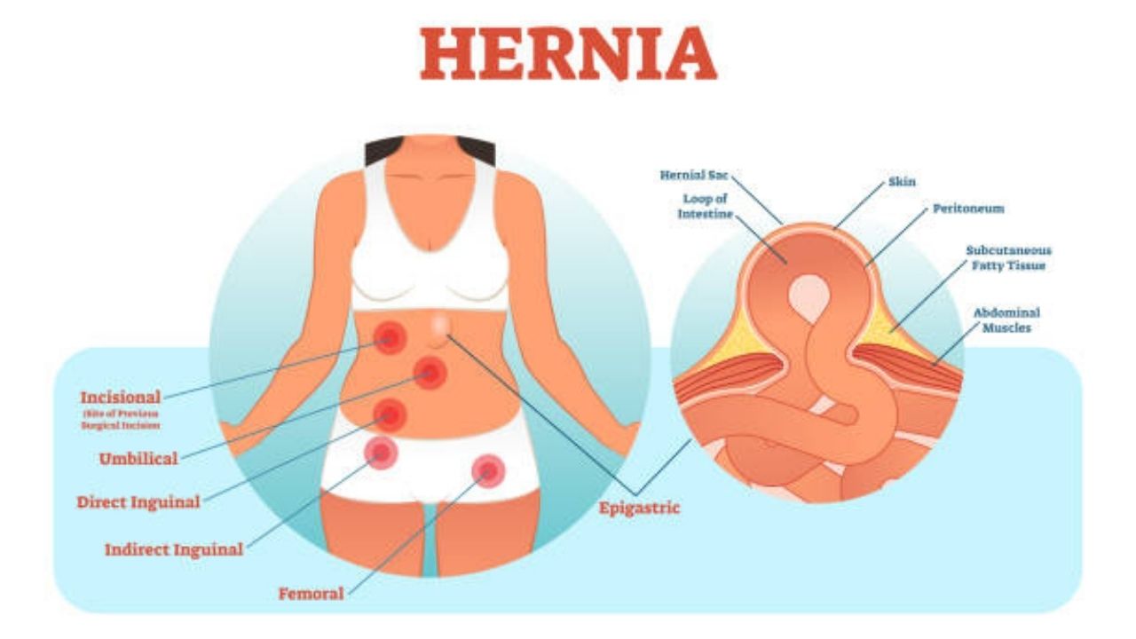 Epigastric Hernia