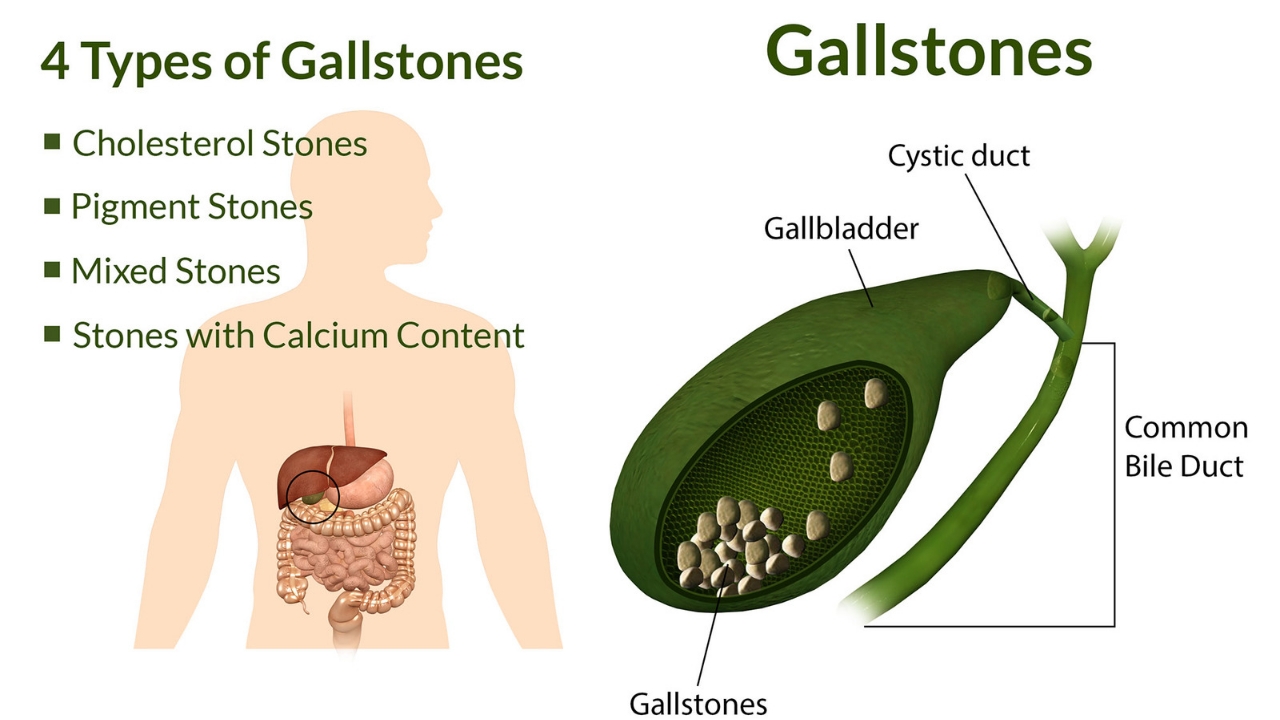 Types of gallstones