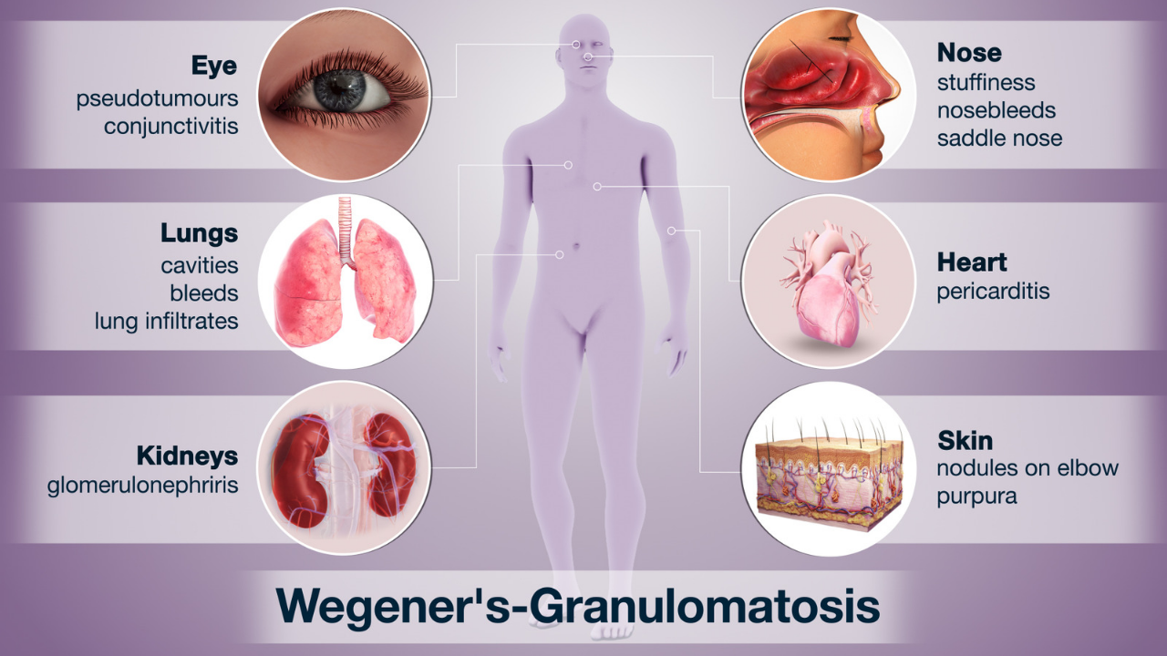 Symptoms of wegener's granulomatosis