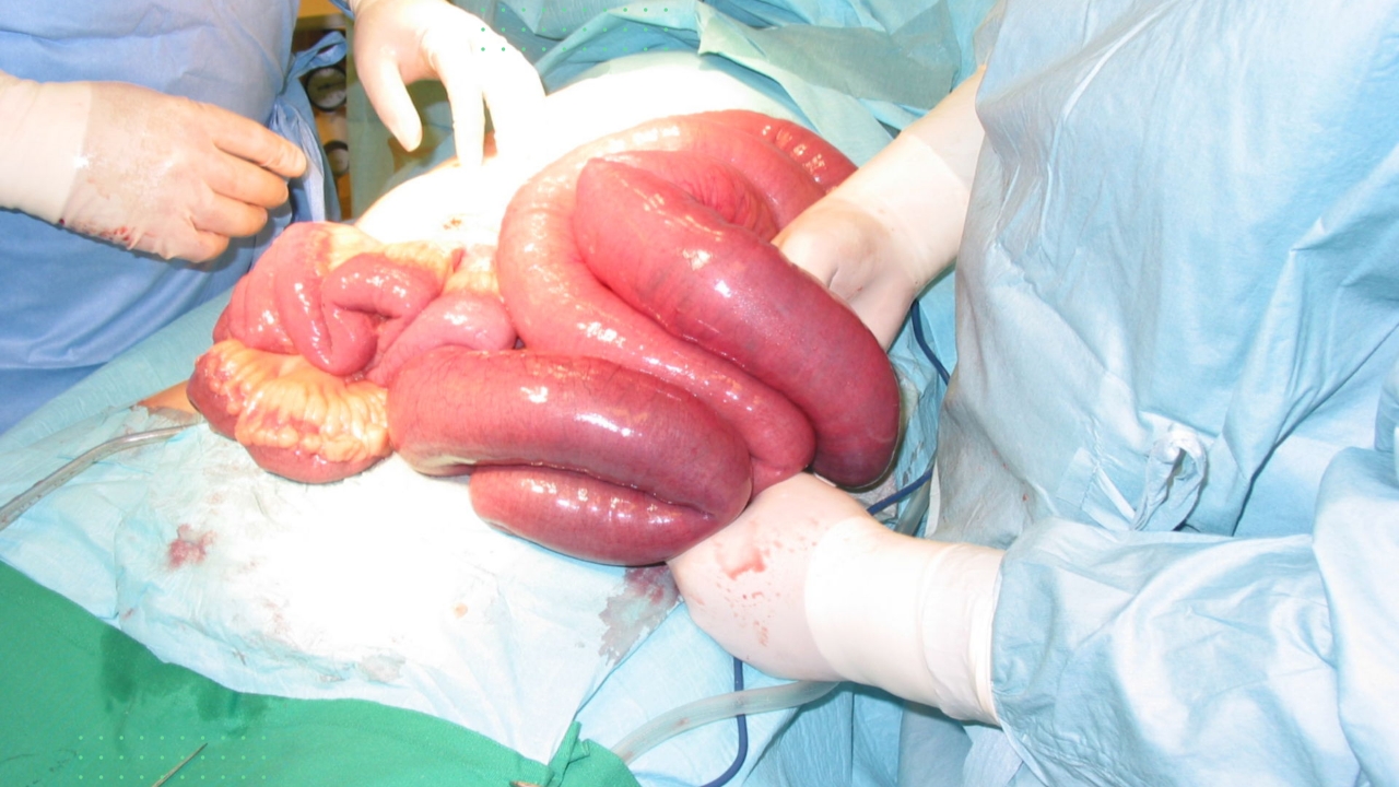 Hernia With Bowel Obstruction