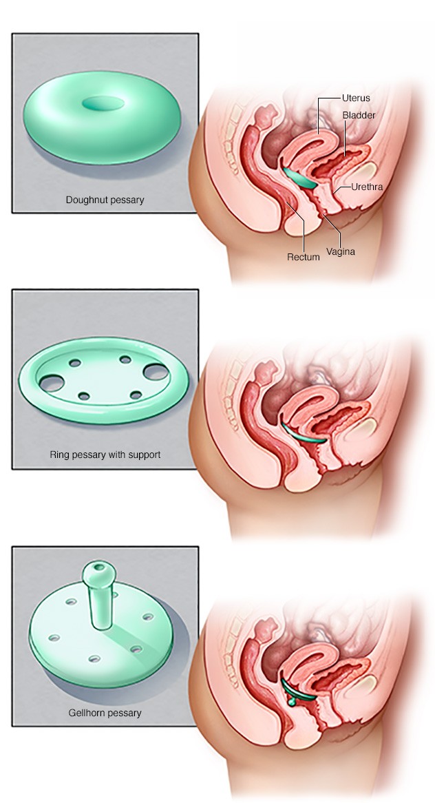 Posterior Vaginal Prolapse