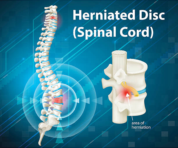 What's Slipped Disc