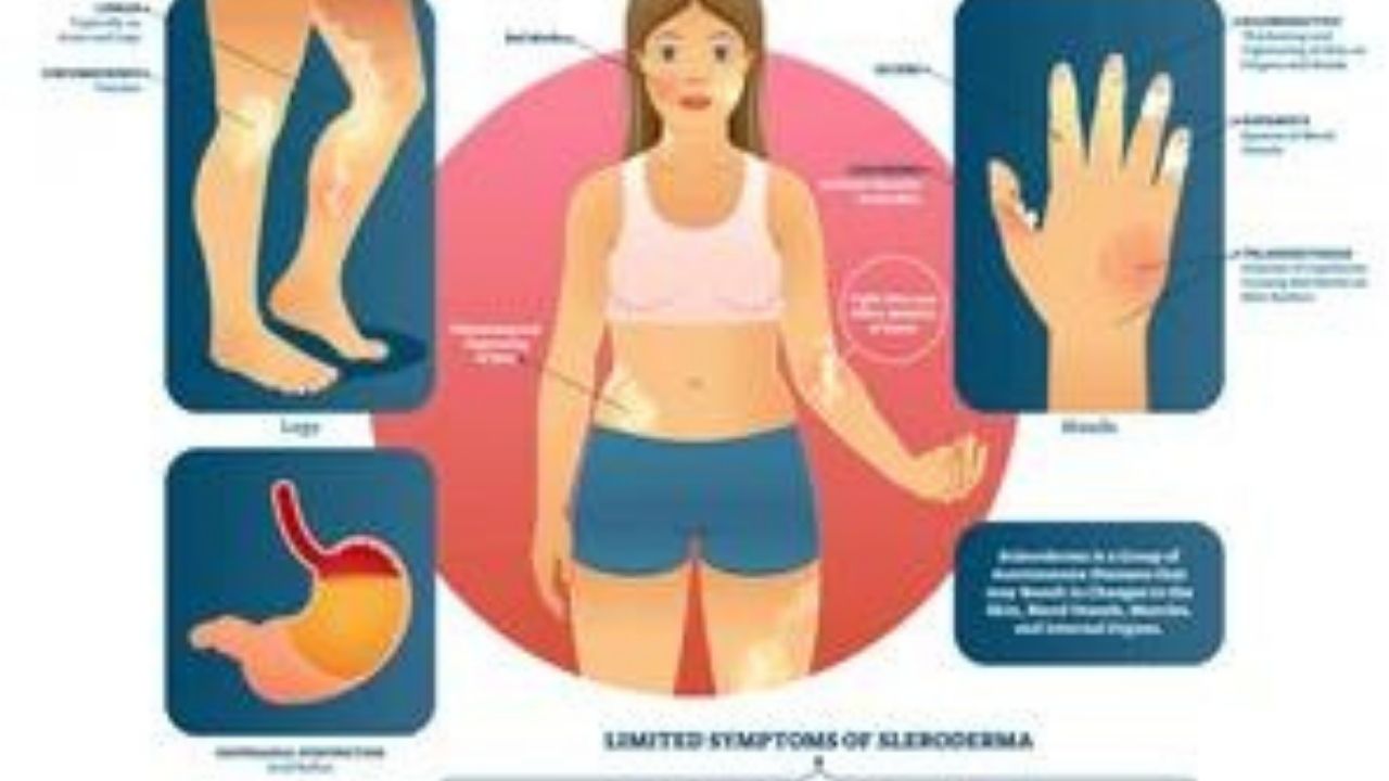 What is scleroderma?