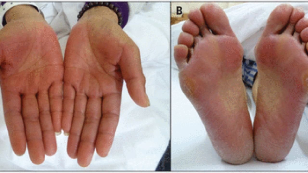 hand foot syndrome