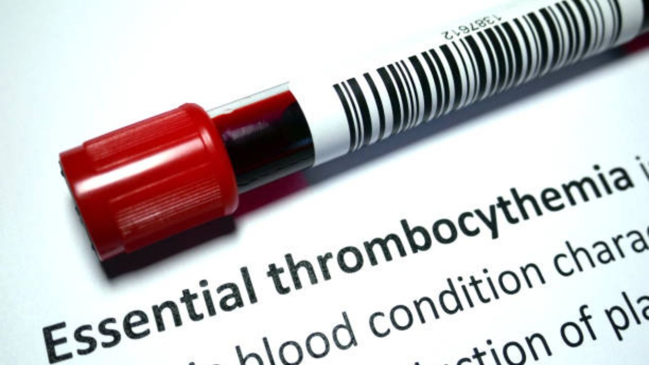 Essential Thrombocythemia