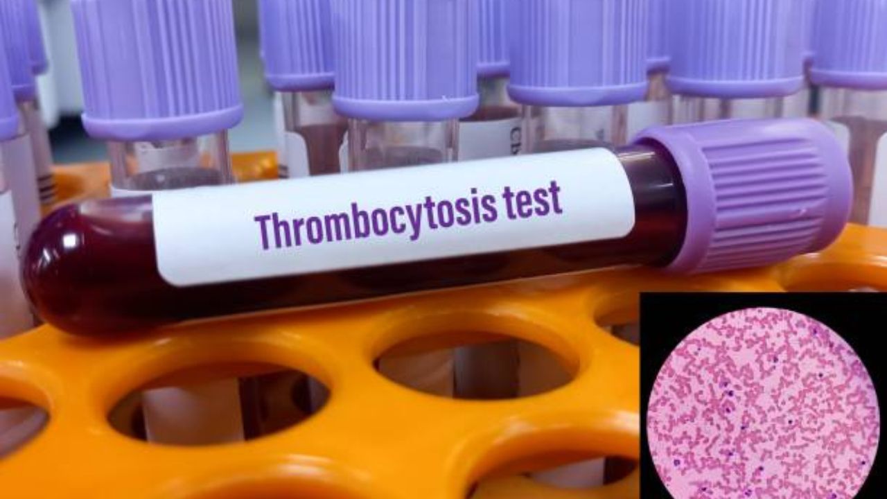 Essential Thrombocythemia